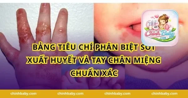 Bảng tiêu chí phân biệt sốt xuất huyết và tay chân miệng chuẩn xác