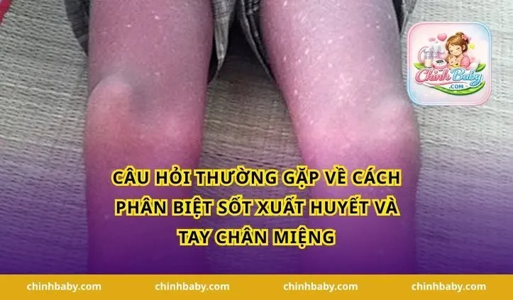 Câu hỏi thường gặp về cách phân biệt sốt xuất huyết và tay chân miệng