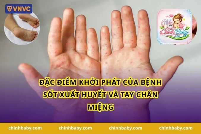 Đặc điểm khởi phát của bệnh sốt xuất huyết và tay chân miệng